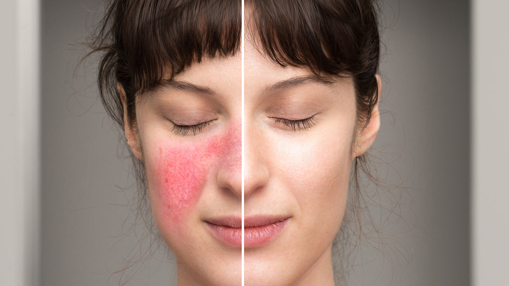 How to Avoid or Treat Sensitive Skin Flare-Ups