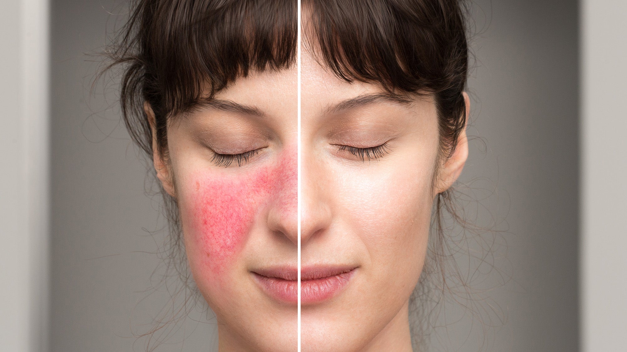 https://lovemyrosieskin.com/cdn/shop/articles/signs-symptoms-rosacea-natural-cures-treatment-skin-disorders_2000x.jpg?v=1678932364